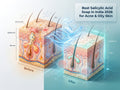 Best Salicylic Acid Soap in India 2026 for Acne & Oily Skin